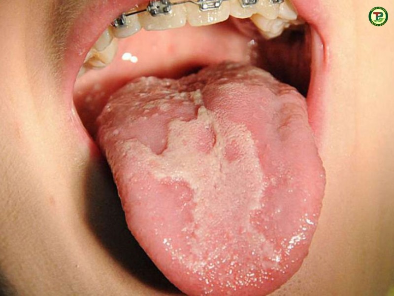 Bị nấm lưỡi do niềng răng và vệ sinh không tốt.